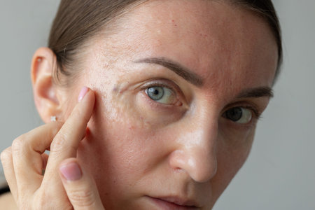 Woman pointing on the bruises on her face after beauty injections. Cosmetology procedures.