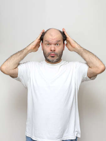 Hair Loss Problem at Middle Age Manの写真素材