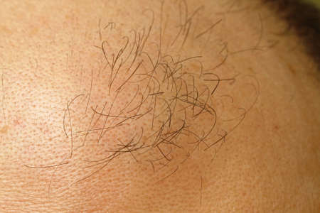 Few Hairs at Bald Head Baldness Problem