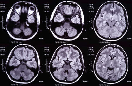 X-ray image of the brain computed tomographyの写真素材