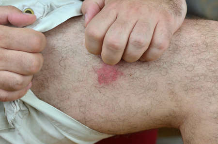 Scratching red irritated skin on the leg at the site of insect bitesの写真素材