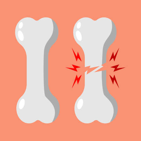 illustration of healthy bones and fractured bones.のイラスト素材