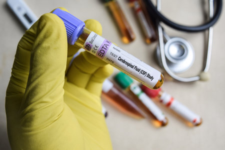 Cerebrospinal Fluid - CSF Test with blood sample in yellow gloved hands. healthcare or Medical conceptの写真素材