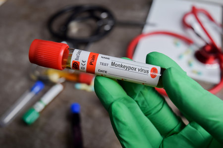 Monkeypox virus vaccination drug in green gloved hands. Medical conceptの写真素材