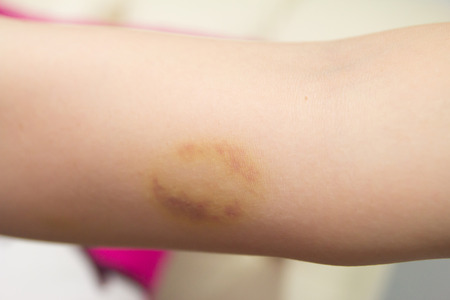 Bruise wound female armの写真素材