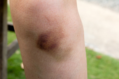 Brown bruise on woman knee backgroundの写真素材