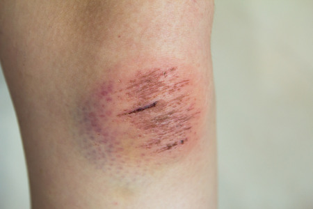 Fresh wound with lymph and blood on asian female knee background