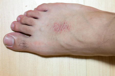 Dry skin and rash at male foot on wood background
