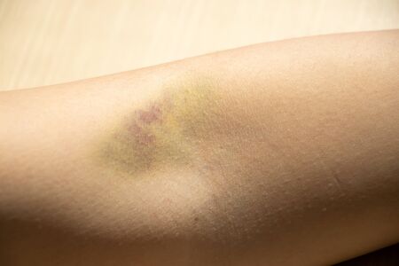 Bruise injury on the female arm background