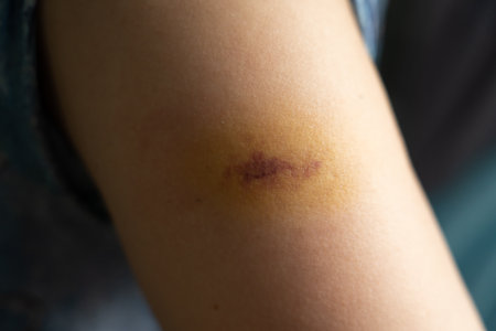 Bruise injury found on the female armの写真素材