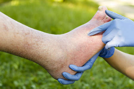 Doctor examining with gloves old patient's ill foot.