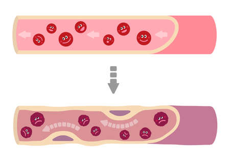 Cartoon illustration that healthy blood turns into muddy blood.のイラスト素材