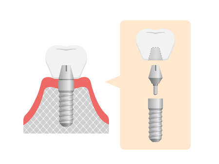 Dental implant flat vector illustration (No text)のイラスト素材