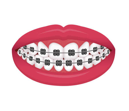 Dental braces vector illustration / no textのイラスト素材