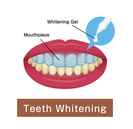 Teeth whitening at home vector illustrationのイラスト素材