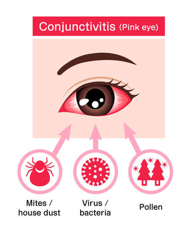 Causes of conjunctivitis (pink eye) vector illustrationのイラスト素材