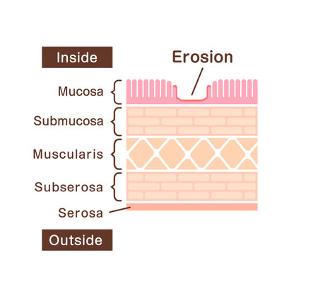 Sectional view illustration  of gastric erosionのイラスト素材