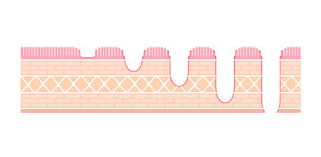 Stages of gastric ulcer ( stomach ulser ) vector illustrationのイラスト素材