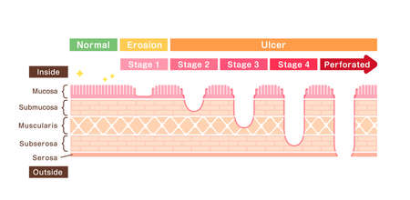 Stages of gastric ulcer ( stomach ulser ) vector illustrationのイラスト素材