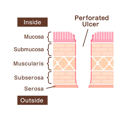 Sectional view illustration  of perforated ulcerのイラスト素材