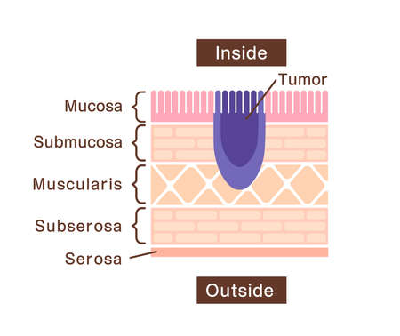 Sectional view illustration of stomach cancer (gastric cancer)のイラスト素材