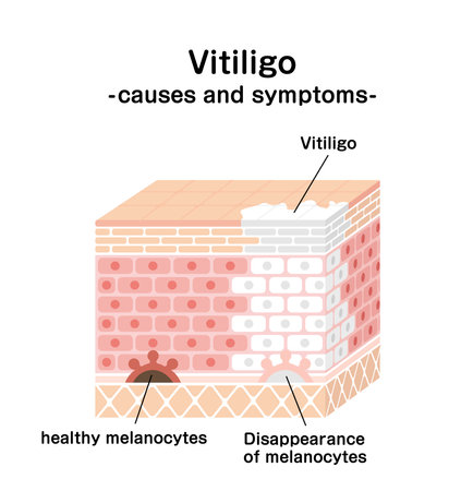 Causes and symptoms of Vitiligo vector illustrationのイラスト素材
