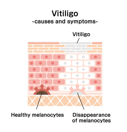 Causes and symptoms of Vitiligo vector illustrationのイラスト素材
