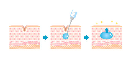 Mechanism illustration of hyaluronic acid injection (cross-sectional view of the skin)のイラスト素材