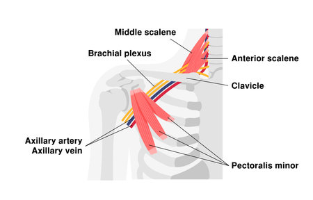 Vector illustration of where thoracic outlet syndrome occursのイラスト素材