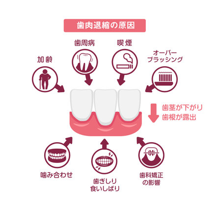 Causes of gingival recession. Vector illustration.のイラスト素材