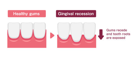 Vector illustration of healthy gums and gingival recessionのイラスト素材