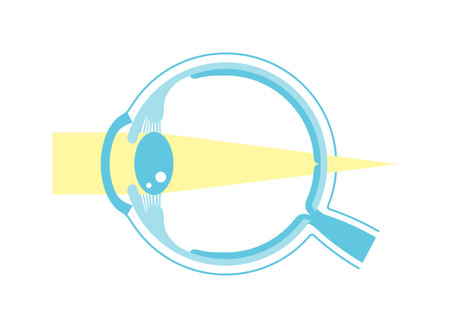 Vector illustration of hyperopia (no text)のイラスト素材