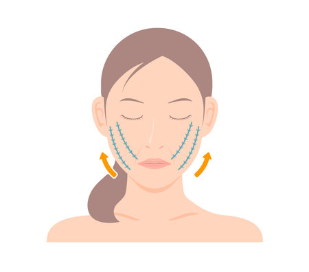 Vector illustration of how a thread lift worksのイラスト素材