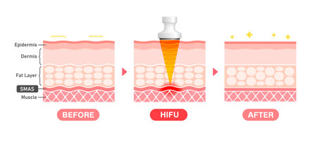 Vector illustration of HIFU mechanism and effect.のイラスト素材