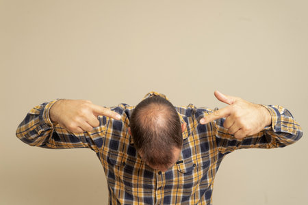 Man pointing at his incipient alopecia with both hands, wears a checked shirt isolated on beige...