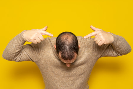 Human alopecia or hair loss. Middle-aged Latino man pointing to his head highlighting his incipient...