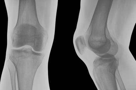 Right knee x-ray shoot.の写真素材