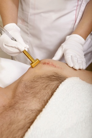 removal of birthmarks, woundの写真素材