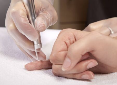 laser removal of wartの写真素材
