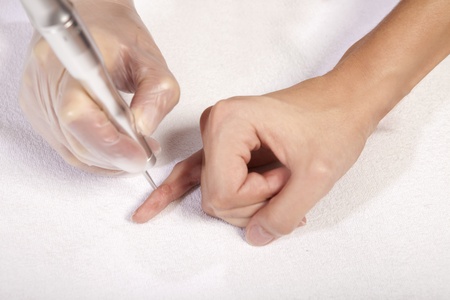 laser removal of wartの写真素材