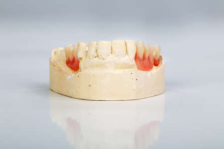 A partial denture mounted on a plaster study model and placed on a shiny gray backgroundの写真素材