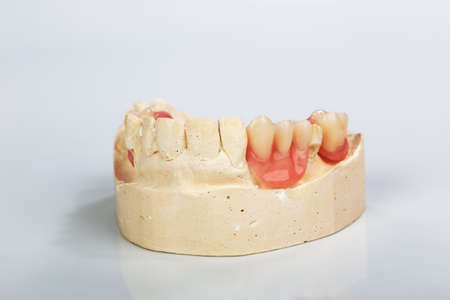 A partial denture mounted on a plaster study model and placed on a shiny gray backgroundの写真素材