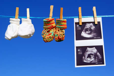 A ultrasound and baby booties are hanging at a clothesline