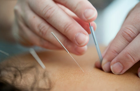 Woman getting acupuncture treatment in a beauty salon. Close-up.の写真素材
