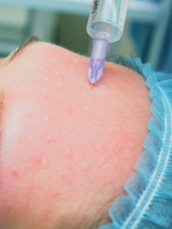 Cosmetology procedure mesoteraphy. Rejuvenation revitalization, skin nutrition, wrinkle reduction. Doctor making microneedle procedure.の写真素材