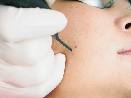 Asian woman patient on laser procedure skin resurfacing in aesthetic medicineの写真素材