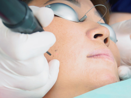 Asian woman patient on laser procedure skin resurfacing in aesthetic medicineの写真素材