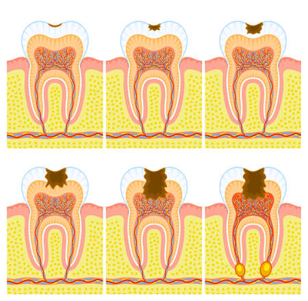 Internal structure of tooth: decay and cariesのイラスト素材