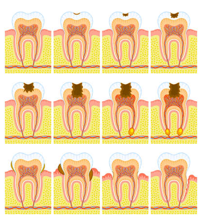Internal structure of toothのイラスト素材