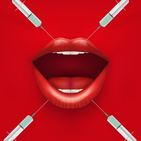 Injection of Treatment with botox or collagen  Lips and syringes  Vector illustration のイラスト素材